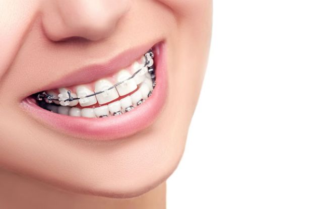 Piękny uśmiech - przegląd aparatów ortodontycznych